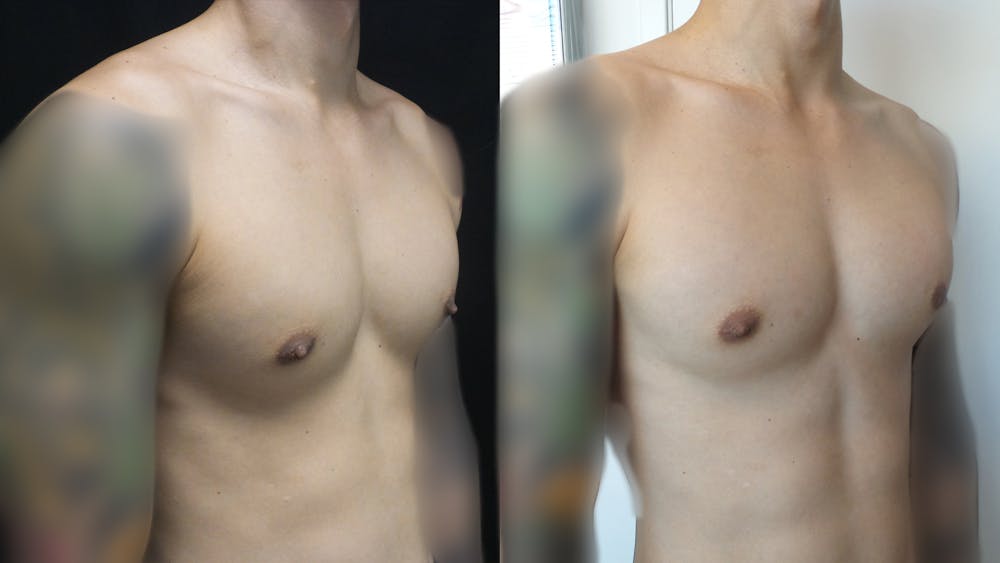 Gynecomastia Before & After Gallery - Patient 54869435 - Image 2