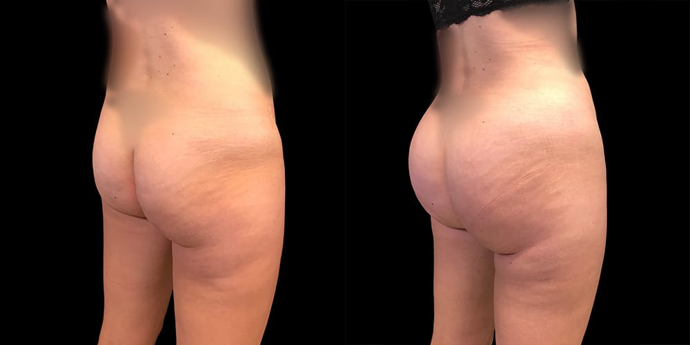 Brazilian Butt Lift Before & After Gallery - Patient 47088231 - Image 1