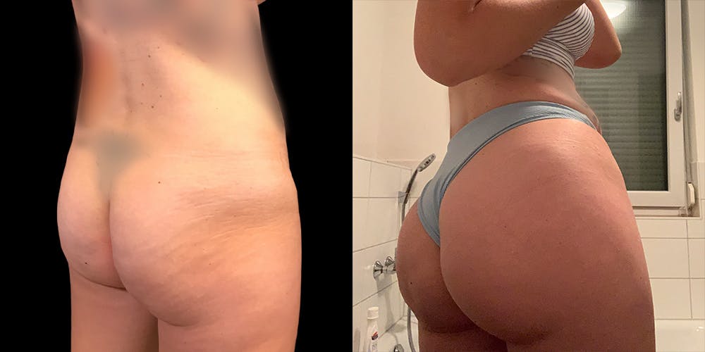 Brazilian Butt Lift Before & After Gallery - Patient 47088231 - Image 2