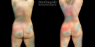 Brazilian Butt Lift Before & After Gallery - Patient 38298977 - Image 1