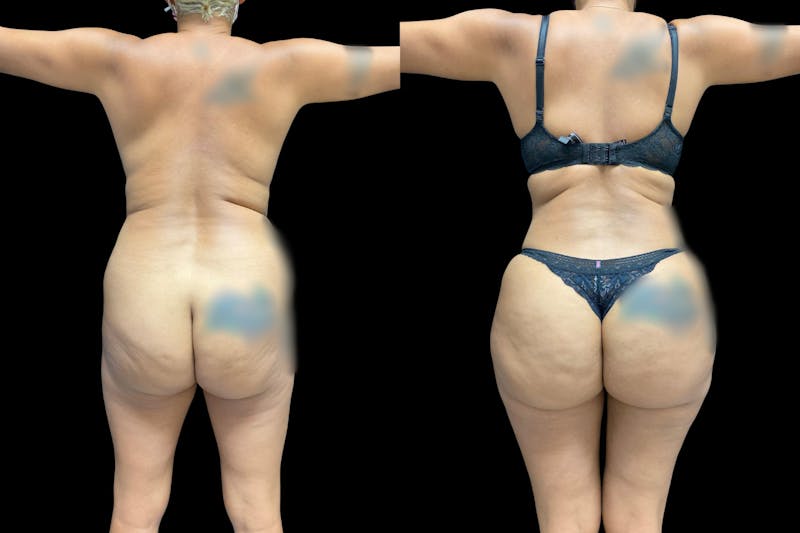 Brazilian Butt Lift