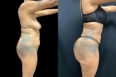 Brazilian Butt Lift Before & After Gallery - Patient 38298981 - Image 2