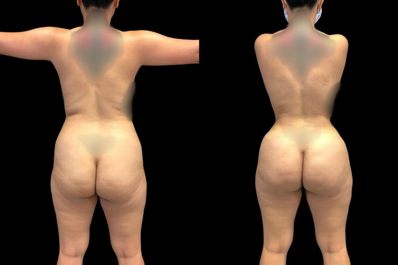 Brazilian Butt Lift
