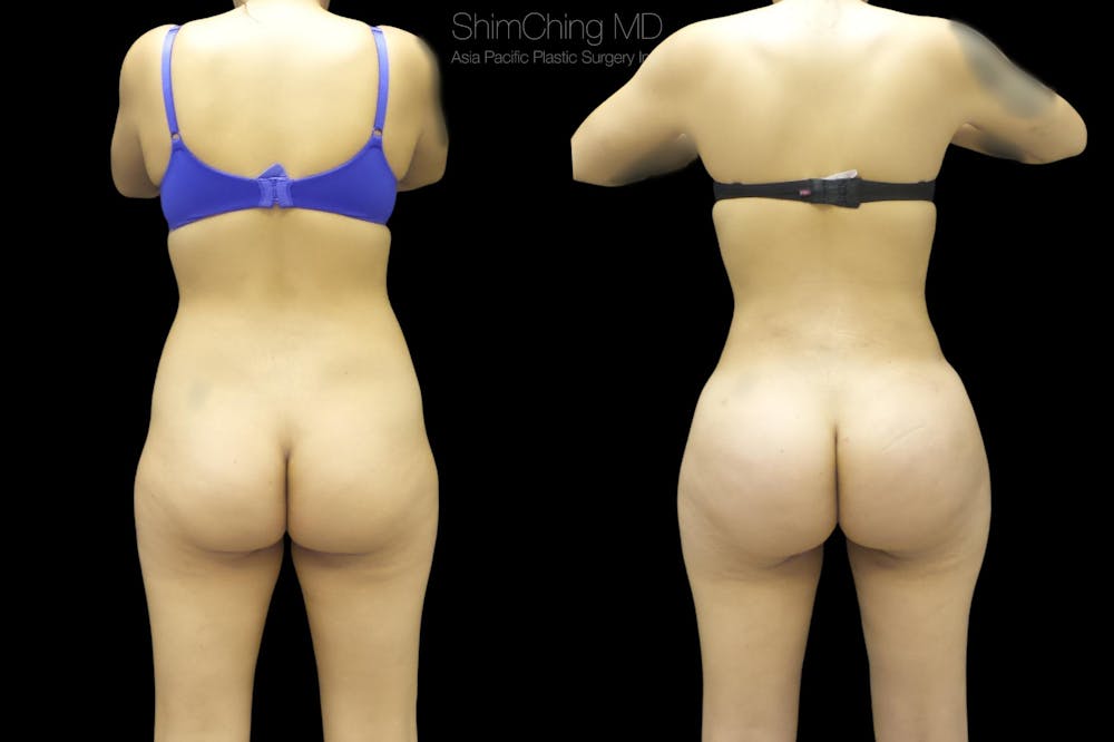 Brazilian Butt Lift Before & After Gallery - Patient 38298992 - Image 1