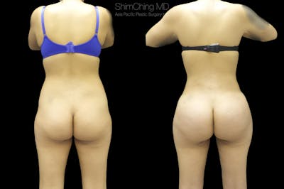 Brazilian Butt Lift Before & After Gallery - Patient 38298992 - Image 1