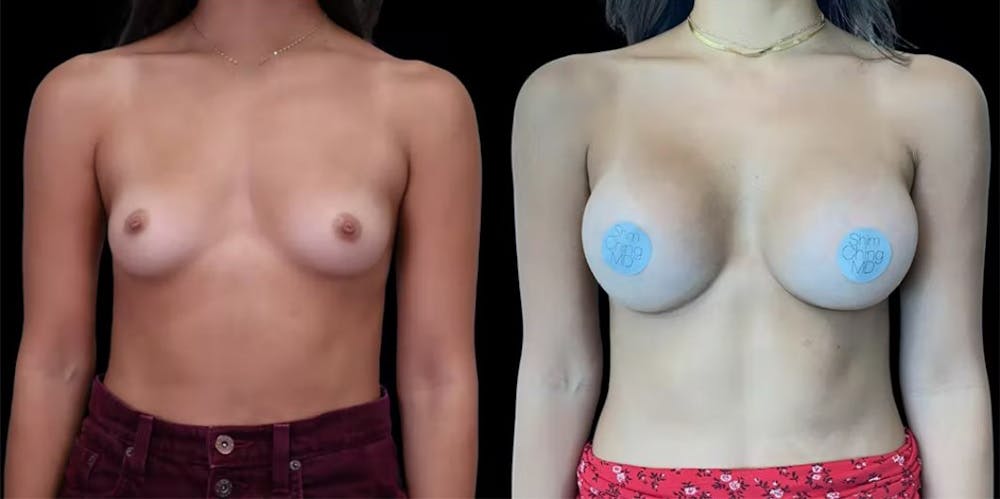 Breast Augmentation Gallery - Patient 47089201 - Image 1