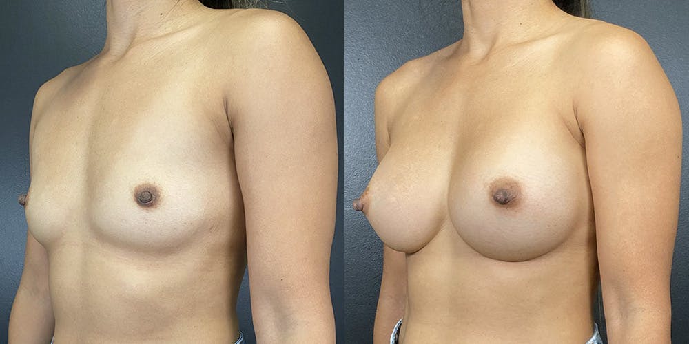 Breast Augmentation Before & After Gallery - Patient 141136666 - Image 1