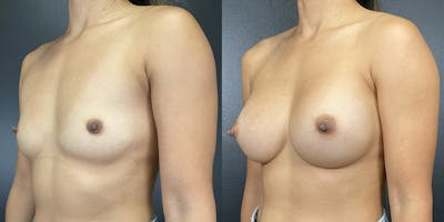 Breast Augmentation Gallery - Patient 141136666 - Image 1