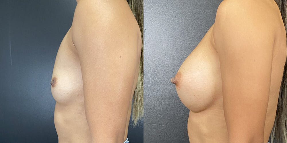Breast Augmentation Gallery - Patient 141136666 - Image 2