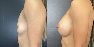 Breast Augmentation Before & After Gallery - Patient 141136666 - Image 2