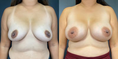 Breast Augmentation Before & After Gallery - Patient 141228981 - Image 1