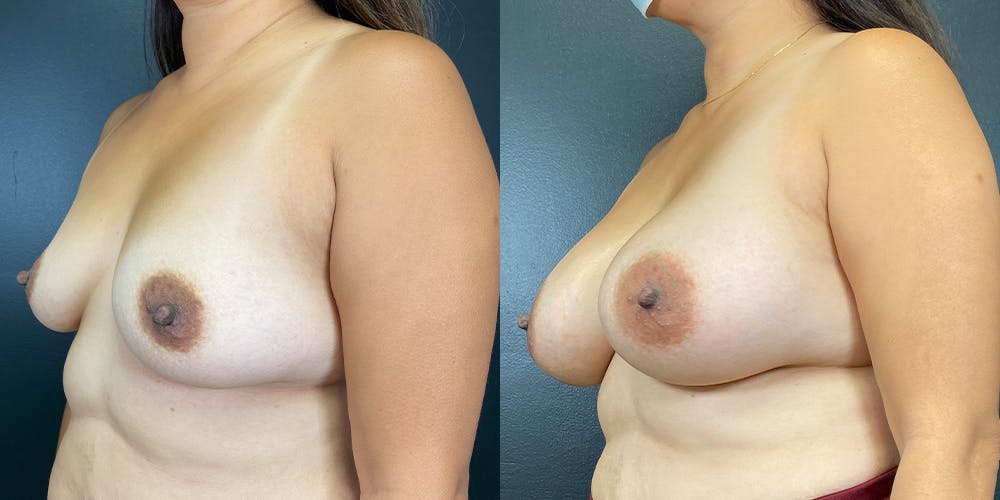 Breast Augmentation Before & After Gallery - Patient 141228981 - Image 5