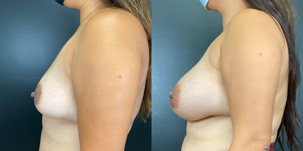 Breast Augmentation Before & After Gallery - Patient 141228981 - Image 6