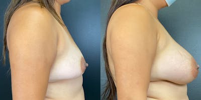 Breast Augmentation Before & After Gallery - Patient 141228981 - Image 4