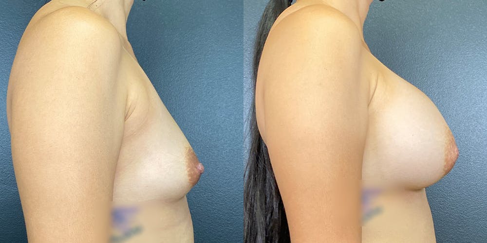 Breast Augmentation Before & After Gallery - Patient 141229459 - Image 3