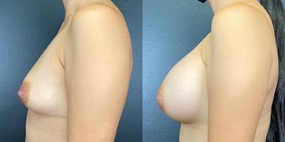 Breast Augmentation Before & After Gallery - Patient 141229459 - Image 4