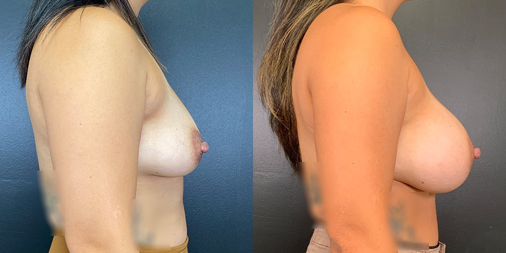 Breast Augmentation Before & After Gallery - Patient 141229650 - Image 4