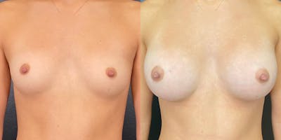 Breast Augmentation Before & After Gallery - Patient 143020118 - Image 1