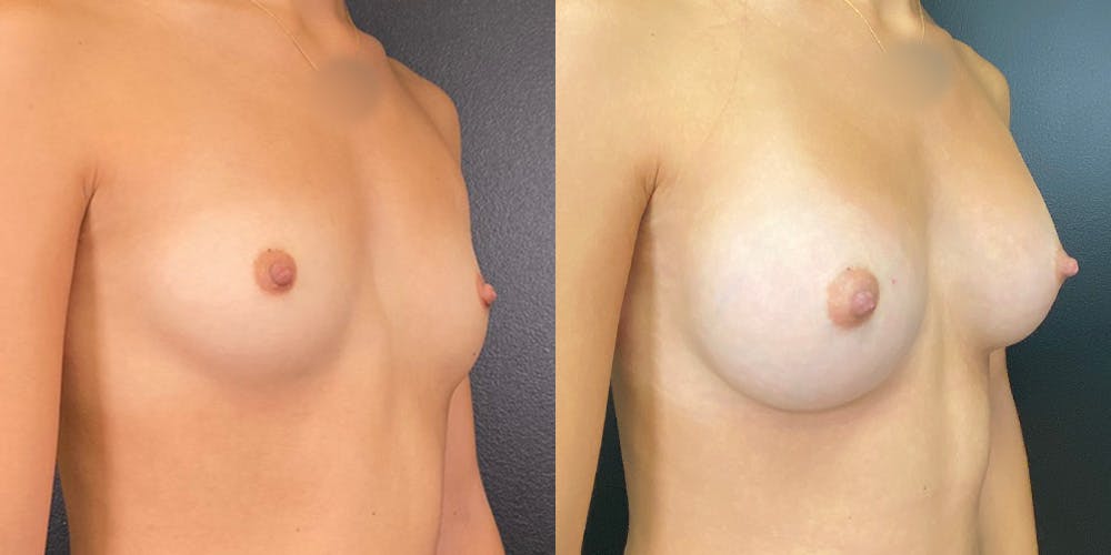 Breast Augmentation Before & After Gallery - Patient 143020118 - Image 2