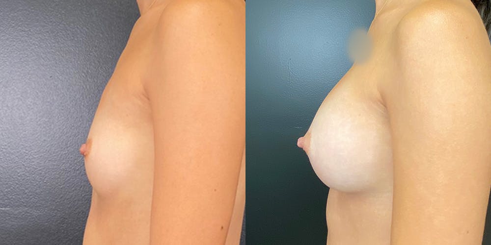 Breast Augmentation Before & After Gallery - Patient 143020118 - Image 5