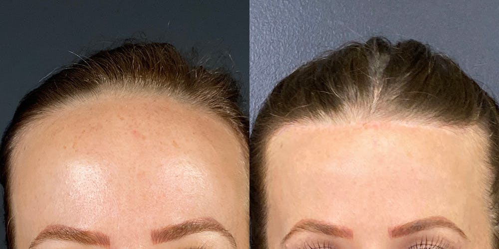 Hairline Advancement Before & After Gallery - Patient 143020141 - Image 1
