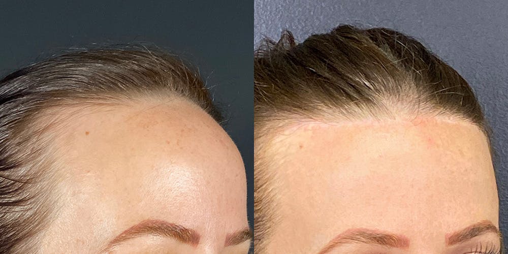 Hairline Advancement Before & After Gallery - Patient 143020141 - Image 2