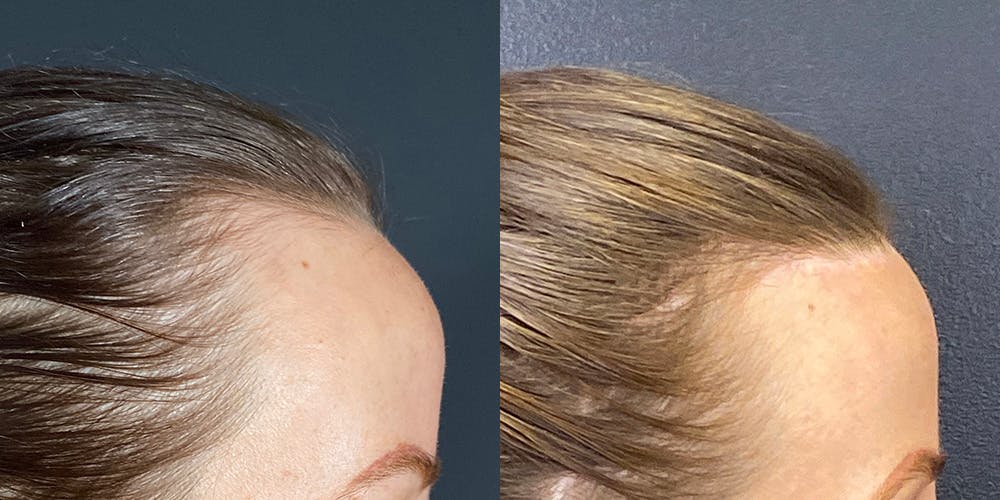 Hairline Advancement Before & After Gallery - Patient 143020141 - Image 3
