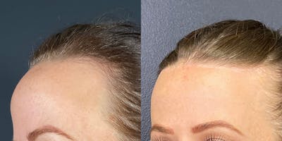 Hairline Advancement Before & After Gallery - Patient 143020141 - Image 4