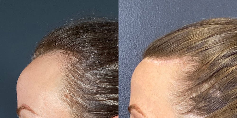 Hair Restoration Before & After Gallery - Patient 318173 - Image 5