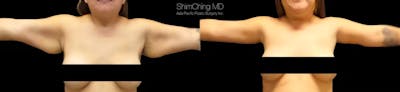 Arm Lift Before & After Gallery - Patient 38298966 - Image 1