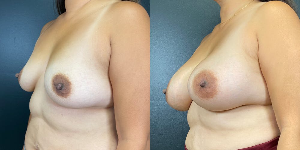 Breast Augmentation Before & After Gallery - Patient 144211727 - Image 3