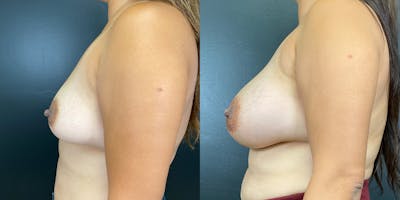Breast Augmentation Before & After Gallery - Patient 144211727 - Image 4