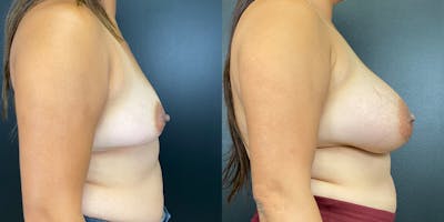 Breast Augmentation Before & After Gallery - Patient 144211727 - Image 6