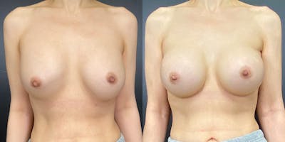Breast Augmentation Revision Before & After Gallery - Patient 144211730 - Image 1