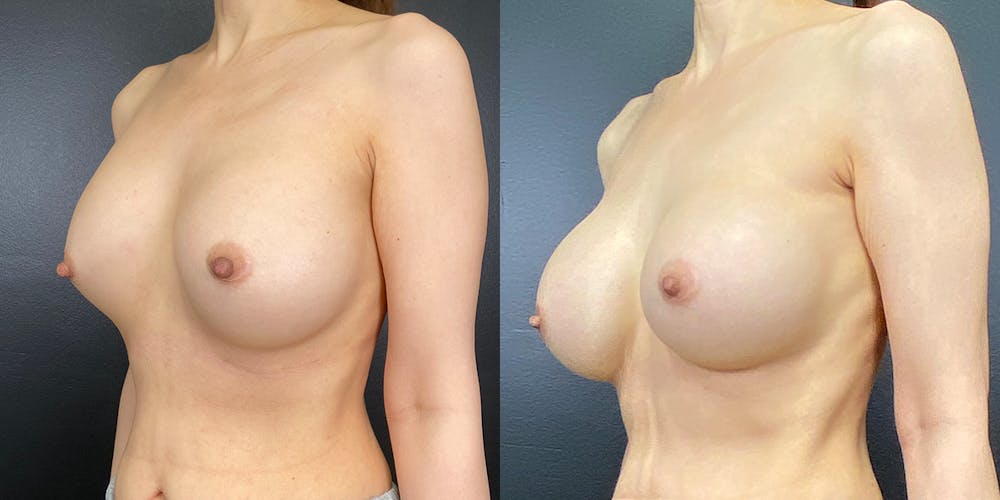 Breast Augmentation Revision Before & After Gallery - Patient 144211730 - Image 2