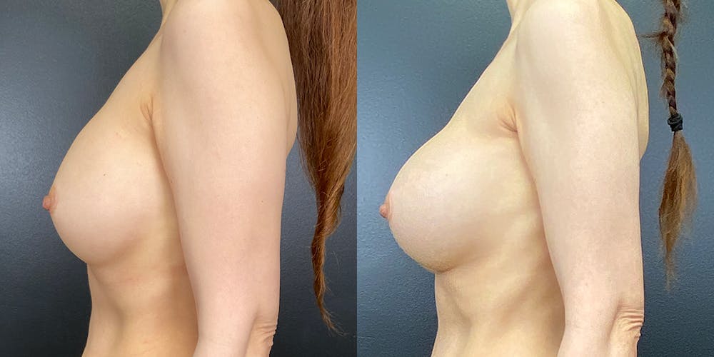 Breast Augmentation Revision Before & After Gallery - Patient 144211730 - Image 3