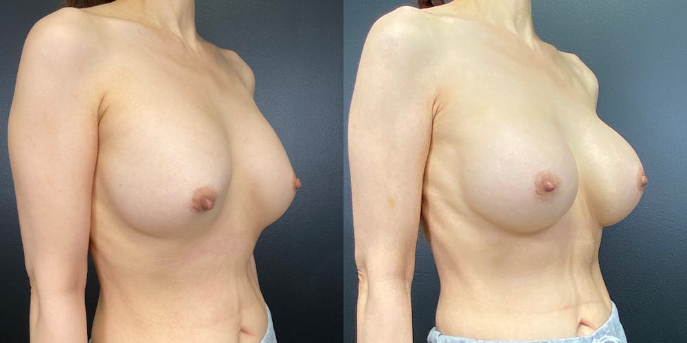 Breast Augmentation Revision Before & After Gallery - Patient 144211730 - Image 4