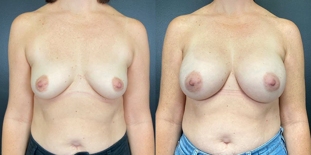 Breast Augmentation Before & After Gallery - Patient 144211734 - Image 1