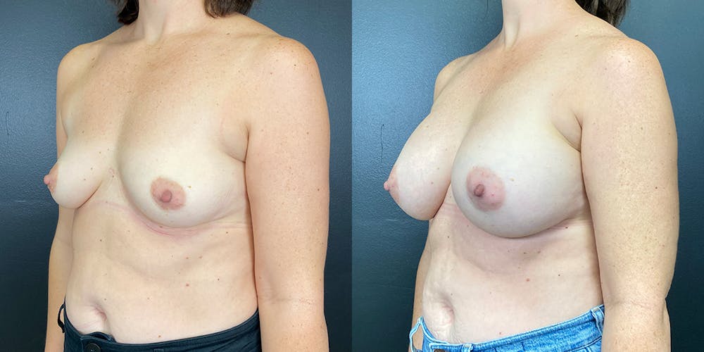 Breast Augmentation Before & After Gallery - Patient 144211734 - Image 3