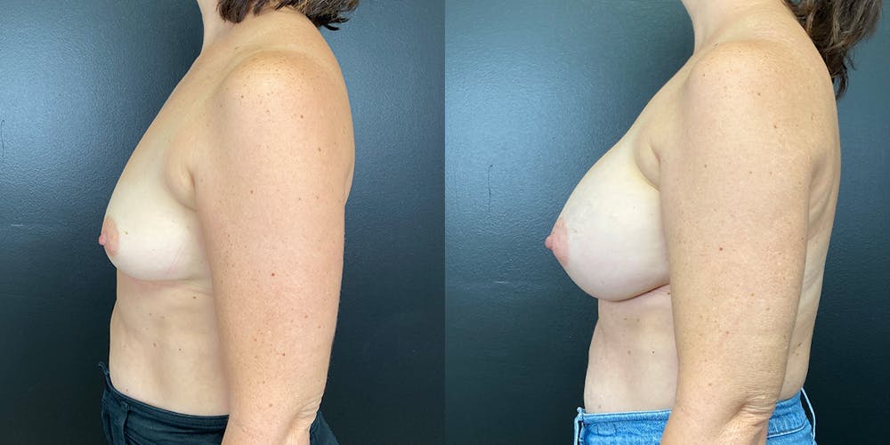 Breast Augmentation Before & After Gallery - Patient 144211734 - Image 4