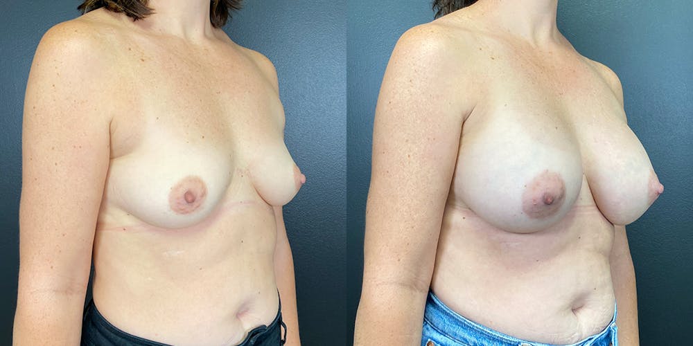 Breast Augmentation Before & After Gallery - Patient 144211734 - Image 5