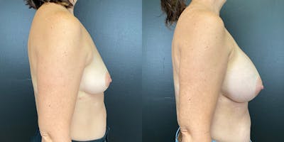 Breast Augmentation Before & After Gallery - Patient 144211734 - Image 6