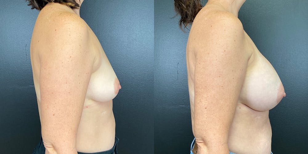 Breast Augmentation Before & After Gallery - Patient 144211734 - Image 6