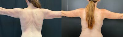 Arm Lift Before & After Gallery - Patient 144211732 - Image 1