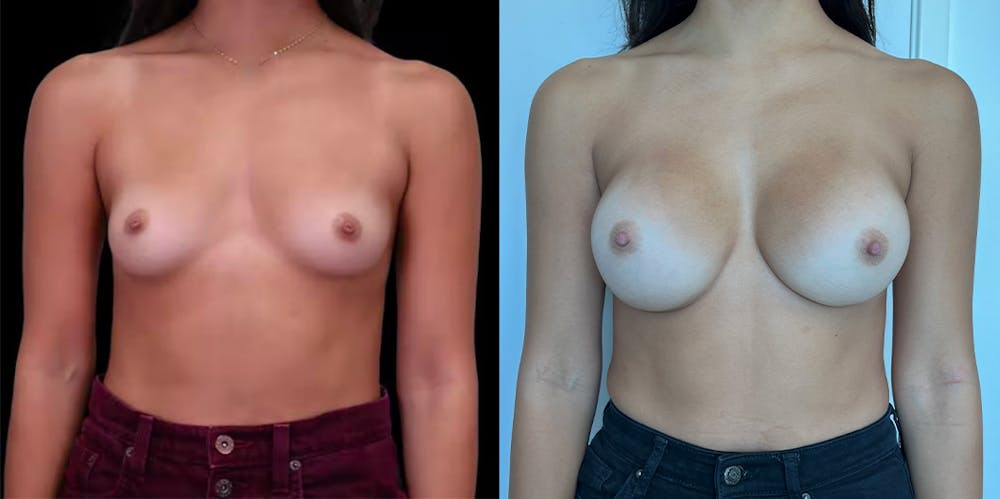 Breast Augmentation Before & After Gallery - Patient 47089201 - Image 1