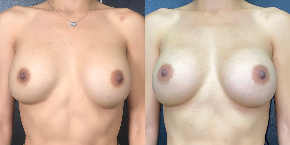 Breast Augmentation Revision Before & After Gallery - Patient 144486708 - Image 1