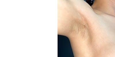 Breast Augmentation Revision Before & After Gallery - Patient 144486708 - Image 2