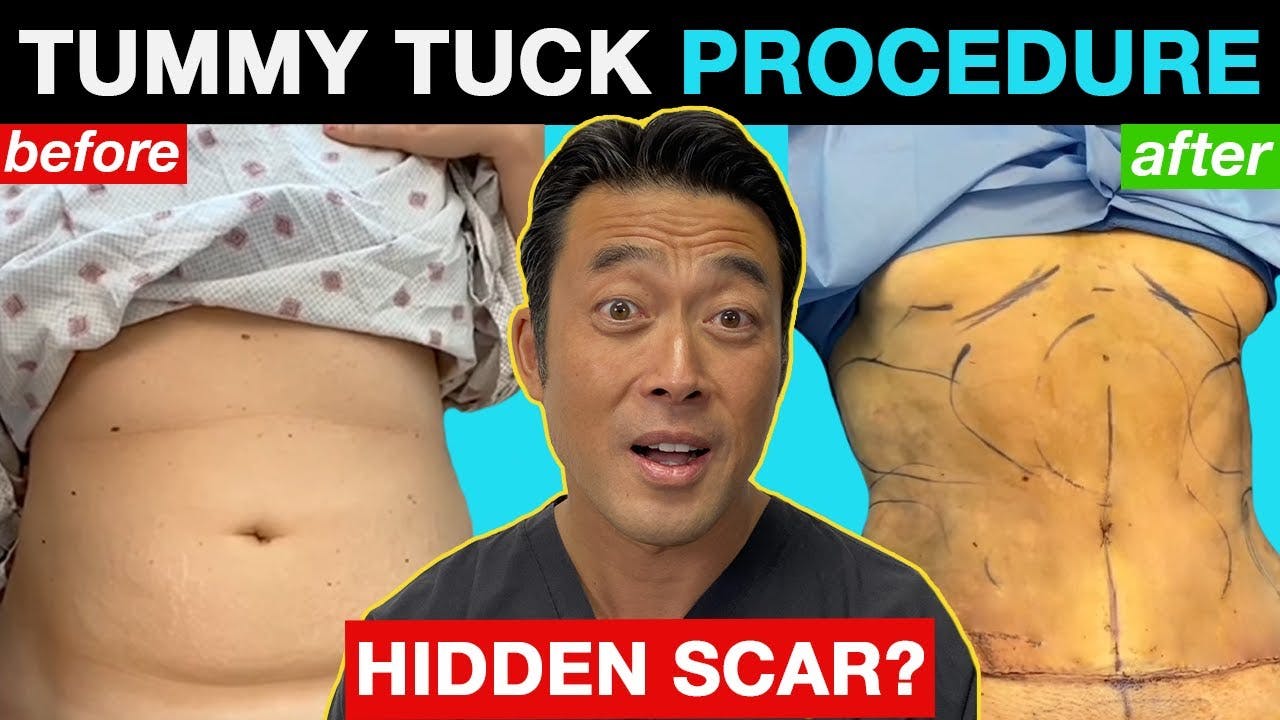 Tummy Tuck Video