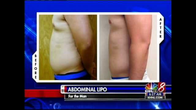 Laser Liposuction Video