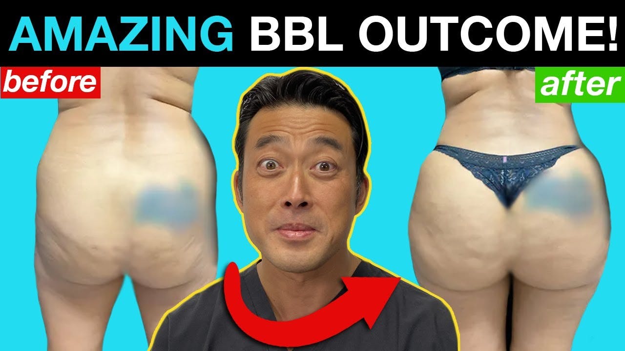 Brazilian Butt Lift Video